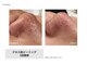 リエリカ 町田(Rerika)の写真/毛穴の開き・黒ずみ・ブツブツを即効ケア！全世代の肌質改善に♪毛穴レスで自信の持てる素肌へ導きます。