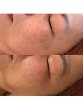 シェリモ(CHERIMO)/しみ改善ケア6回目の結果