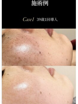 アンヘル(Angel)/リアボーテハーブトリートメント