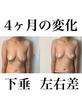 サロンツキ(salon tuki)/【バストケア】症例★