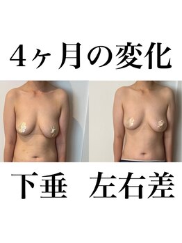 サロンツキ(salon tuki)/【バストケア】症例★