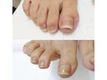 リゼラアンドコー 布施店/巻き爪ケア！