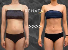 レナータ 渋谷店(RENATA)の雰囲気（【脂肪冷却】Before・After◎腹部ぺったんこ・渋谷・都度払い）