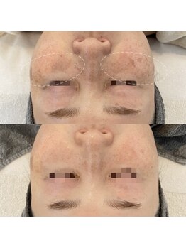 グレーシス(Graces)/シミ経過