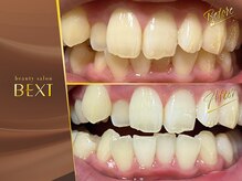 ベクスト(BEXT)/セルフホワイトニング