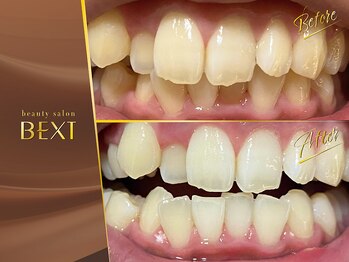 ベクスト(BEXT)/セルフホワイトニング