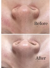 ナロウ(Narow)/鼻の黒ずみもスッキリ♪