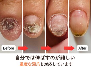 ネイルサロン プロムナード(nailsalon promnade)/諦めていたお爪もご相談ください
