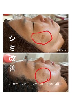 サロン ド グランツィア(salon de Granzia)の写真/あきらめないで!シミ・シワ・老け顔。ハーブピーリングでタイムスリップ!ボヤッとしみでお悩みの方にも◎