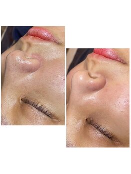 ハイビューティー 渋谷(Hi Beauty)/毛穴洗浄♪最高の結果出し!