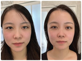 アンベリール(EMBELLIR)/ご新規限定フェイシャルプラン