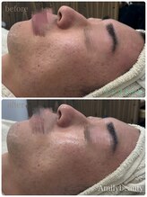 アミリービューティー ひたち野うしく店(Amily beauty)/アンストレス