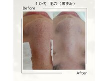 毛穴トリートメントパック