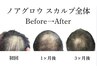 短期集中【頭皮ケア】ノアグロウ導入！頭皮全体的に気になる方