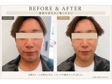 エヌ(N)の雰囲気（ハーブピーリングで透明感がでました。浮腫みも軽減されました。）