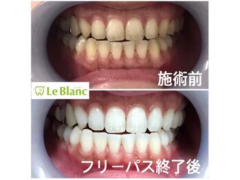 ルブラン 奈良店(Le Blanc)/本来の歯のお色まで