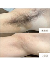 ボヌール 久留米(Bonheur)/ワキ脱毛