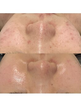 ミューズ(MUSE)/エクストラクション＋美顔フォト