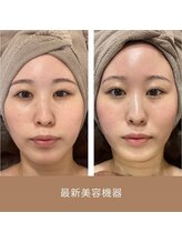 リム ビューティー(RYM BEAUTY)/小顔超音波