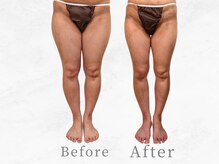 アファン 鶴見店(Afun)/痩身BeforeAfter