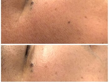 イディアル(IDE'AL)/韓国肌管理スタンダード１回目