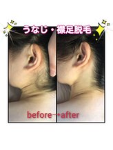 ルミナ(Lumina)/うなじ脱毛Before→after