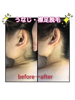 ルミナ(Lumina)/うなじ脱毛Before→after