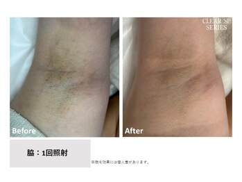 ハナフク(hanafuku)/before→after