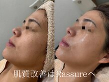 ラシュール(Rassure)/老け肌解消 アンストレス
