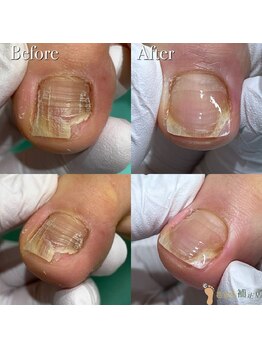 巻き爪補正店 越谷店/巻き爪補正