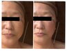 【リフトUPフェイシャル】たるみや浮腫み、くすみ、疲れ顔改善★