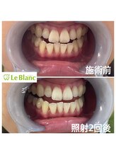 ルブラン 奈良店(Le Blanc)/えっ！！こんなにも白く！！