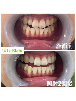 ルブラン 奈良店(Le Blanc)/えっ!!こんなにも白く!!