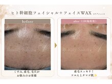 エース(A)の雰囲気(気になる【産毛・くすみに】フェイスWAXでツルんとたまご肌☆)
