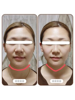 アンティクイーン(Antiqueen)/リフトアップ、むくみ改善