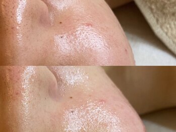 ブラン ネージュ(Blanc Neige)/ハーブトリートメント