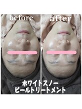 ピュルテ/シミやくすみにお悩みの方へ