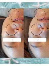 ポノ(Pono)/1回のBefore/After☆