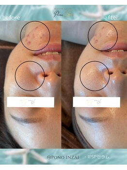 ポノ(Pono)/1回のBefore/After☆