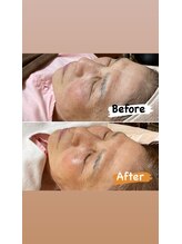 ホジュン鍼灸整体院/セラピール×美容鍼3回目