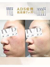 ラヴレボーテ(La Vraie Beaute)/自己症例