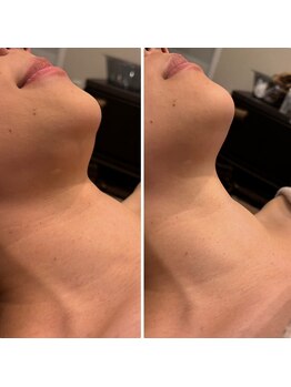 ビュウナ 銀座(BEAUNA)/マルチウェーブリフト