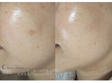 グレイス モリヤ(Grace Moriya)の雰囲気（レーザー後の炎症後色素沈着の改善に☆）