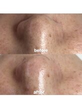 ビューティーネイル(Beauty Nail)/毛穴エクストラクション