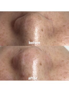 ビューティーネイル(Beauty Nail)/毛穴エクストラクション