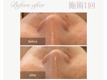 パルタージュ(Partage)/毛穴／黒ずみケア