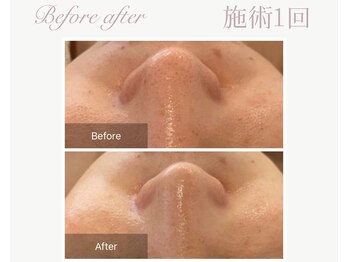 パルタージュ(Partage)/毛穴／黒ずみケア