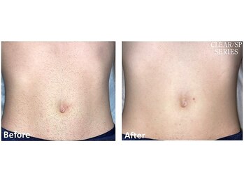 セラス(CERAS)/男性のお腹脱毛