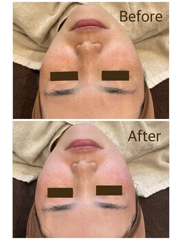 ライエ(Raie)/フェイスワックス脱毛