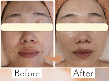 ニコリ(NICOLI)/予約殺到！肌管理コース♪